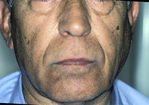 Left parotid tumor in a patient with primary Sjögren