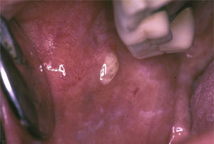Purulent discharge from Stensen