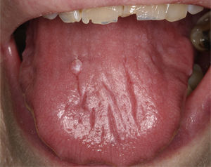 Glossy, depapillated tongue due to hypersalivation in a patient with primary Sjögren's syndrome. The image also shows a papilloma on the dorsum of the tongue and fractured incisal edges of the upper teeth.