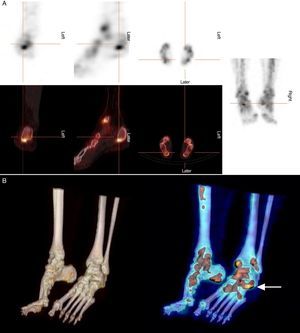 A. Axial, sagittal and coronal images obtained by bone SPECT/CT showing increased osteoblastic activity in left tibial malleolus, talus and talocalcaneal joint (cross). B. 3D reconstructions of the fusion images that enabled the precise localization of the point of entrapment (arrow).