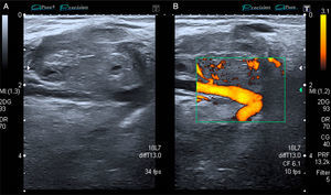 (A) Gray scale iso/hypoechoic image of a round, heterogeneous and moderately well-defined lesion. (B) Image with Doppler signal activated showing the vessel that feeds the metastatic lesion.