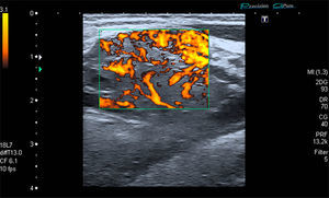 Color Doppler image showing the hypervascularity of the highly heterogeneous lesion, findings that rule out malignancy.