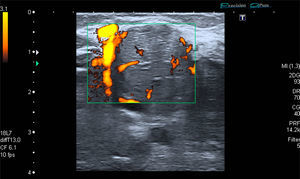 Doppler image showing a round form and grade 1 signal in the lesion and hypervascularity due to an adjacent vessel.