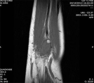 T1-weighted magnetic resonance image (sagittal plane) of the forearm. Round, well-defined iso/hyperintense mass in the muscle of right forearm, with chemical shift artifact with fat saturation.
