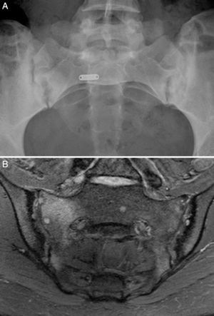 Case no. 1. (A) Radiography of sacroiliac joints showing widening, erosions and bilateral sclerosis, which corresponds to bilateral grade 3 sacroiliitis. (B) Magnetic resonance image of sacroiliac joints showing sclerosis, erosions and marked bone marrow edema, all signs of active sacroiliitis.