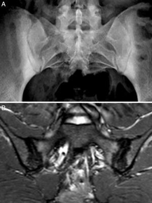 Case no. 2. (A) Radiography showing marked bilateral sclerosis in both bone margins of the sacroiliac joints. (B) Magnetic resonance image of sacroiliac joints showing sclerosis, erosions and bone marrow edema, signs of active sacroiliitis.