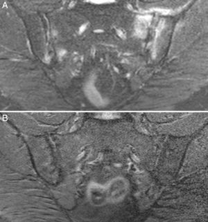 Case no. 3. (A) Magnetic resonance image showing asymmetric bilateral changes with bone marrow edema in both joints and capsulitis in left sacroiliac joint, signs of active sacroiliitis. (B) Complete resolution of bone marrow edema and capsulitis after 17 months on the gluten-free diet.