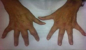Synovitis in several proximal metacarpophalangeal and interphalangeal joints.