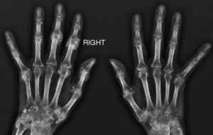 Amorphous periarticular calcifications with polylobulated margins, without bone destruction, in the areas of different joints.