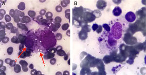 Enlarged view of the histiocyte with vacuolated cytoplasm phagocytosing a hematopoietic cell.