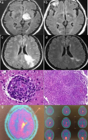 Case no. 1: Axial fluid-attenuated inversion recovery (FLAIR) magnetic resonance image (MRI) shows a hyperintense lesion in left thalamus (a). In an image acquired 2 months later, complete resolution of the lesion is observed (b). Case no. 2: Axial FLAIR MRI shows a hyperintense lesion in white matter of the left frontoparietal region, extending to the cortex and corpus callosum, in a gadolinium-enhanced image (c). MRI performed after 20 days of corticosteroid therapy shows a significant reduction in the hyperintense area (d). Histopathological findings in brain biopsy show a perivascular lymphocytic infiltrate with blood vessel involvement (hematoxylin-eosin) (e). Granulomatous inflammatory infiltrate (hematoxylin-eosin) (f). Brain 11C-methionine positron emission tomography (PET) images showing parasagittal deposition of 11C-methionine suggestive of possible lymphoma (g and h).
