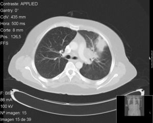 Pulmonary computed tomography showing condensation in left upper lobe, in contact with the anterior costal pleura and accompanied by ipsilateral hilar adenopathy.