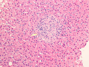 Liver biopsy showing non-necrotizing lobular granuloma (arrow) surrounded by the hepatic parenchyma, with no changes in its architecture.