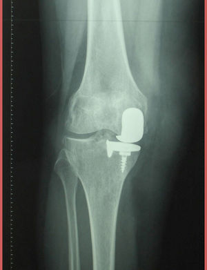 Anteroposterior radiograph of right knee showing the unicompartmental prosthesis.