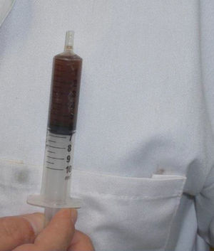Joint fluid obtained during arthrocentesis.