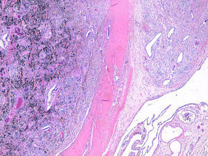 Synovial biopsy: black pigment infiltrating the synovial tissue.