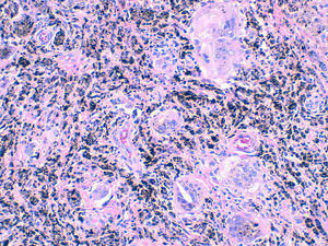Synovial biopsy: macrophages loaded with metallic pigments and lymphocytic infiltrate.