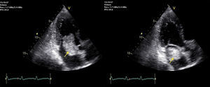 Transthoracic echocardiogram with an apical view of 3 chambers showing a tumor in left atrium, in diastole (left) and in systole (right).