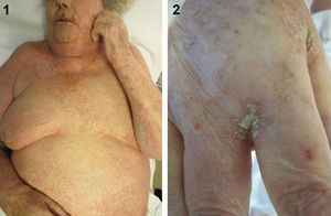 (1) Hyperkeratotic plaques and numerous linear burrow tracks distributed on the patient