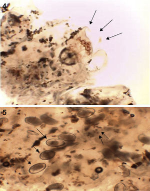 (4) Image from the histological study under direct vision (at 400×) showing a mite (arrows) and feces. (5) Histological study under direct vision (at 400×) showing eggs (arrows) and feces.