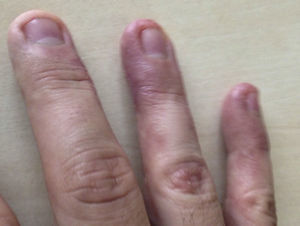 Eczematous lesions with fissures in the skin on the outer side of the pads of the 3rd, 4th and 5th fingers of the dominant hand. Erythema with a few vesicles, scaling and painful fissures in the skin are observed.