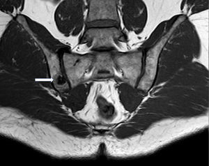 Semicoronal plane of sacroiliac joint in a T1-weighted image, showing a hypointense area on the border of the iliac side of the right sacroiliac joint, with an isointense central zone.