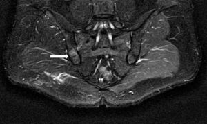 Semicoronal plane of sacroiliac joint in a STIR sequence, showing a hyperintense area on the border of the iliac side of the right sacroiliac joint, with an hypointense central zone.