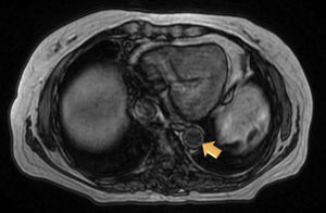 Magnetic resonance angiographic image of thoracic aorta and the upper portion of abdominal aorta showing a somewhat thickened aortic wall, reaching a thickness of approximately 1.7mm in prerenal aorta, with atheromatosis in thoracoabdominal aorta.