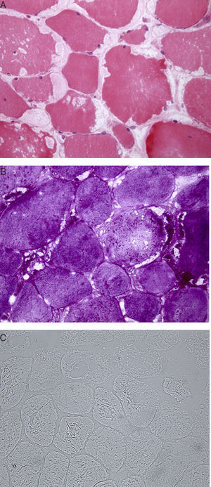 (A) Multiple clear vacuoles containing eosinophilic granules located in the sarcolemma. (B) Periodic acid Schiff (PAS) staining showing deposits of PAS-positive glycogen granules within the vacuoles. (C) Absence of myophosphorylase in the histochemical study.