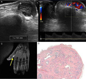 (A) Ultrasound image in B mode showing a 7.5-mm lesion in the soft tissue of the proximal phalanx of the first digit of the left hand. (B) Spectral Doppler ultrasound showing a low-resistance arterial waveform. (C) Fat-saturation T2-weighted magnetic resonance image showing the hyperintensity of the lesion (arrow). (D) The pathological study using hematoxylin–eosin staining revealed numerous vascular spaces surrounded by an endothelium with no atypical features, lying on a stroma with hyalinized papilla.