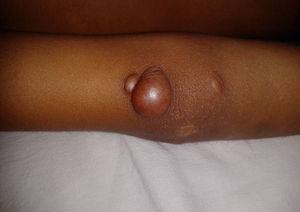 Tuberous xanthoma in elbow.