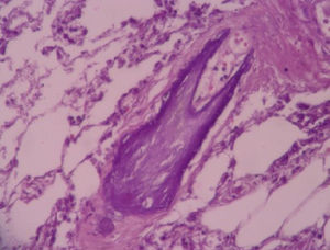 Vascular calcification (hematoxylin & eosin, 40×).