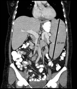 Abdominal computed tomography showing massive splenectomy, with a maximum diameter of 21cm.