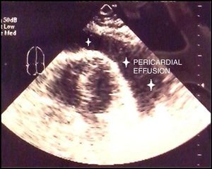 Echocardiogram showing massive pericardial effusion (stars).