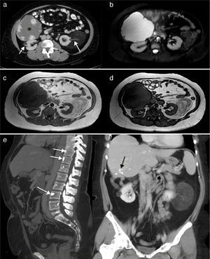 (a) Renal computed tomography (CT) showing a giant hepatic hemangioma (*) and bilateral low-density renal angiomyolipomas, similar to fat and the vascular pedicle (arrows). (b) Axial short-tau inversion recovery (STIR) images. The hepatic hemangioma is markedly hyperintense and the renal angiomas show low signal intensity with a few hyperintense areas on the left that represent the tumor vascularization. (c and d) T1-weighted gradient echo images in phase and reversed phase, respectively, showing the left renal angiomyolipomas with an intensity similar to fat, and hypointense areas in its interior that correspond to the vascular structures. The reversed phase image (d) shows that the signal of part of the tumor is canceled out because of the fat content. (e) Sagittal maximal intensity projection (MIP) reconstruction of CT images, showing a few vertebral bodies corresponding to bone islands (arrows). (f) Coronal MIP reconstruction of CT images. The hepatic hemangioma has been resected and the black arrows indicate the clips that remained after surgery. The 2 renal angiomyolipomas are clearly seen.