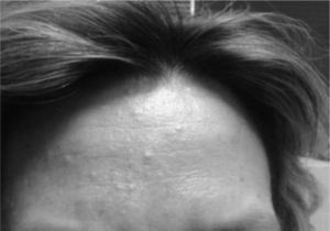Facial angiofibromas.