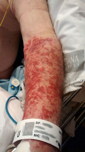 Image of the lesion beneath the mark of the blood pressure cuff.