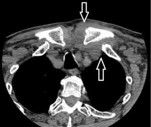 Augmentation of soft tissue and obliteration of fat planes associated with the inflammatory-infectious process in left sternoclavicular joint (arrows).