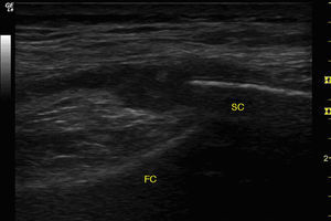 Ultrasound of right knee. Longitudinal view of the external parapatellar recess showing marked synovial proliferation of homogeneous aspect. FC, femoral cortex immediately adjacent to the lateral femoral condyle; SC, superficial cortex of the lateral patellar border.