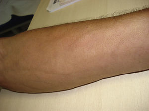 The groove sign (furrows along the veins of the superficial plexus) and “peau d’orange” aspect are observed in the patient's left forearm.