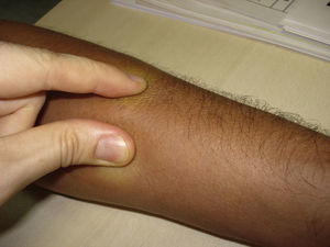 Erythema and marked induration and thickening of the skin that makes tweaking it impossible.