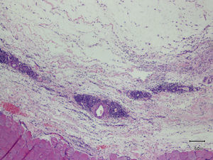 Thickening and edema of the muscle fascia, with presence of a diffuse, perivascular lymphocytic inflammatory infiltrate.