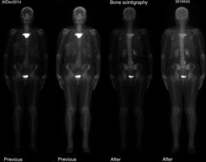 Bone scintigraphy. Diffuse blastic lesion in sternal manubrium.