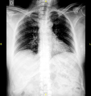 Chest radiograph. Rib cage.