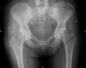 Radiograph of the hip.