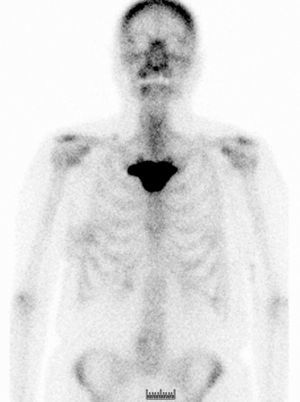Chest computed tomography. Sclerosis in sternal manubrium.
