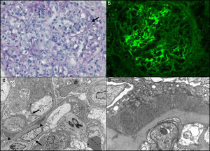 (a) Glomerulus of distorted architecture due to the marked mesangial and endocapillary hypercellularity with mononuclear and polymorphonuclear cells, characteristic of an acute diffuse proliferative pattern. There are images suggestive of subendothelial immune complexes (arrow) (PAS staining, 400×). (b) Direct immunofluorescence of a glomerulus with thick and thin granular deposits of IgG, both mesangial and in certain capillary loops (stained with fluoresceinated anti-IgG antibody; 400×). (c) Transmission electron microscopy showing a glomerulus with a distorted architecture and 2 adjacent capillary loops with marked intracapillary hypercellularity. The image shows focal dense subepithelial deposits (arrowheads). There is focal reduplication of basement membranes that characterize an incipient membranoproliferative lesion (arrows) (osmium tetroxide–uranyl citrate, 6000×). (d) Transmission electron microscopy showing a segment of a capillary loop, in which we see segmental and confluent dense subepithelial deposits that have substructures organized in microtubules measuring 40–50nm in diameter (osmium tetroxide–uranyl citrate, 16,000×).