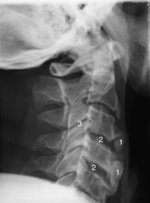 Radiography of lateral cervical spine (2009) showing ossification of anterior cervical ligament, which has a greater effect on the lower cervical segment (1). The intervertebral disc spaces (2) and facet joints are conserved (3).