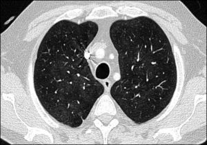Computer tomography showing a subtle increase in the ground glass density in upper thorax, predominantly in central and upper lobes, suggestive of an alveolar inflammatory process.