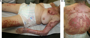 (A) Scaly, maculopapular eczema on trunk and extremities. (B) Trunk involvement.